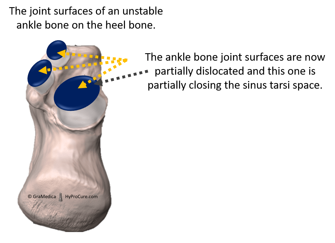 The joint surfaces of an unstable ankle bone on the heel bone