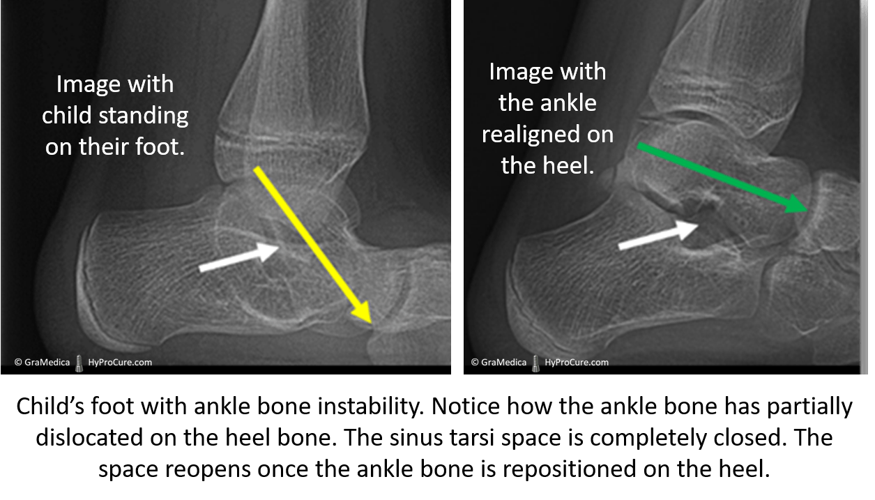 Child's foot with ankle bone instability