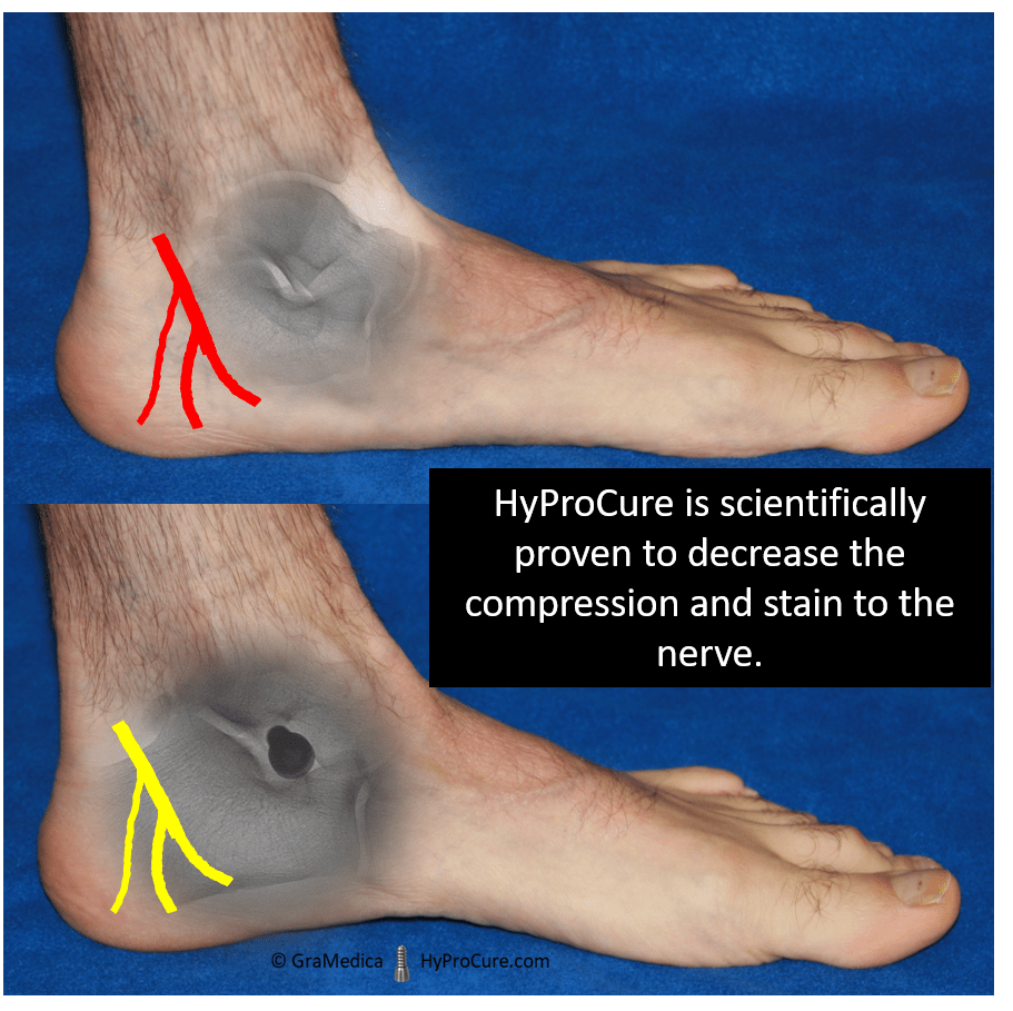 Plantar neuropathy outlet