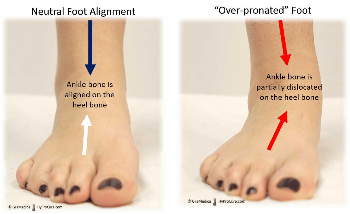 Toe pronation new arrivals