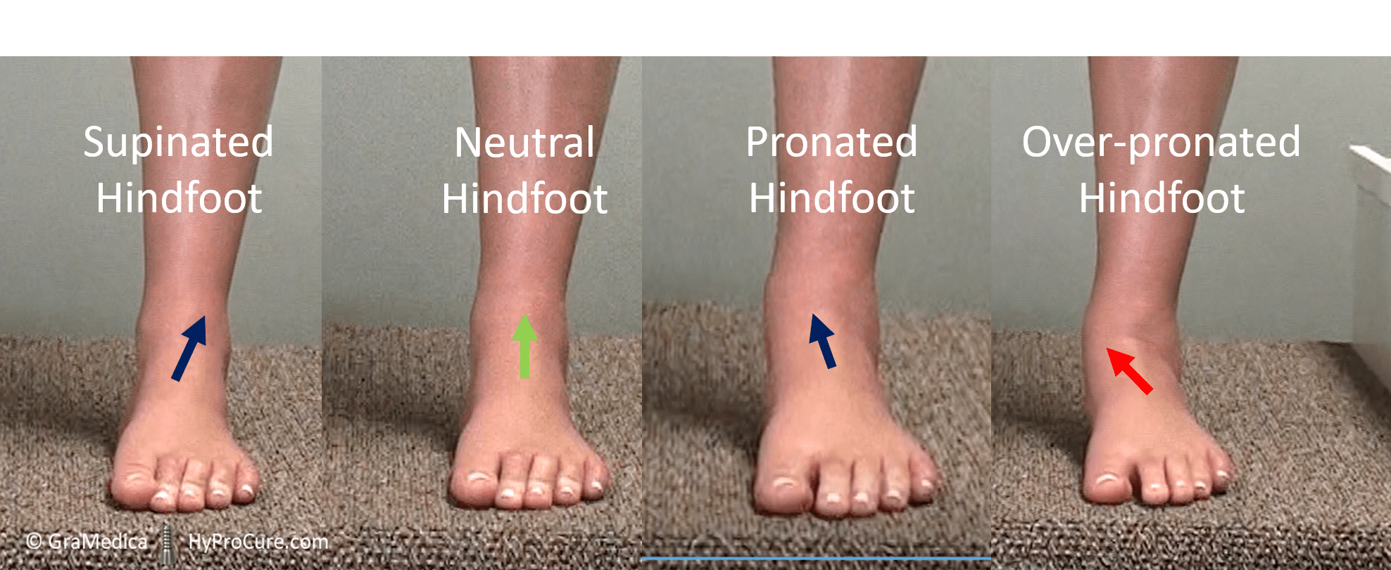 Misaligned over pronated feet GraMedica
